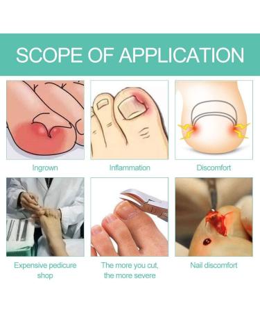 Ingrowing Nail Corrector Ingrown Toenails Correction Paronychia Corrector Ingrowing Nail Corrector Ingrown Toenail Correction Paronychia Ingrown Toenail Correction Tool Foot Care Tool (set 40) - Buy Online on GoSupps.com
