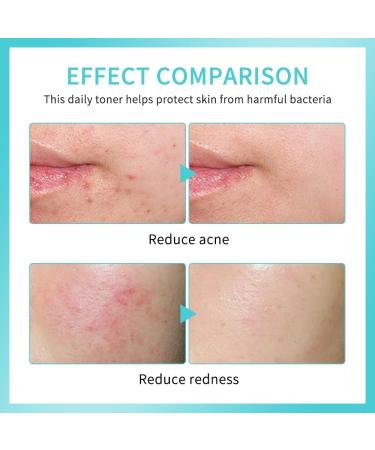 YLBHYIRSJF Hypochlorous Acid Face and Skin Spray Safe for use on Acne Prone Skin Soothing Facial Spray Hydrating Face Mist Skin Care Products for Sensitive Skin 3 Pcs - Buy Online on GoSupps.com