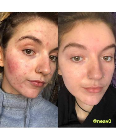 Carbon Theory | Tea Tree Oil & Glycolic Acid Exfoliating Breakout Control Cleansing Pads | Natural Vegan And Cruelty Free | 60 Pads - Buy Online on GoSupps.com