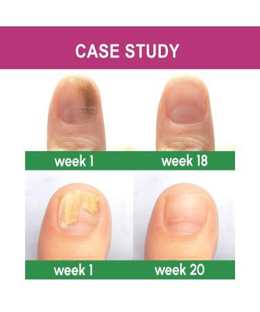 Extra Strength Toenail Fungus Treatment - Nail Repair Solution for Discolored Nails - Renew Damaged Toenails - Fingernail & Toenail Fungus Treatment - Buy Online on GoSupps.com