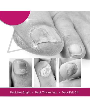 Nail Care Solution Ginger Nail Essence Repair Serum Repairs Nail Corners Cuticle Barb Finger Protection Finger Edge Oil Nail Repair 2 pieces - Buy Online on GoSupps.com