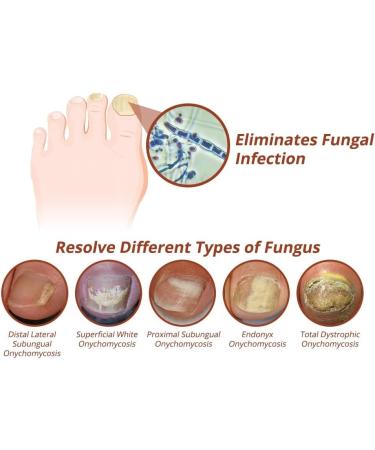 GFOUK 7 Days Nail Growth And Strengthening Serum Fungal Nail Treatment Serum Nail Strengthening Treatment Stronger Nails in - Buy Online on GoSupps.com