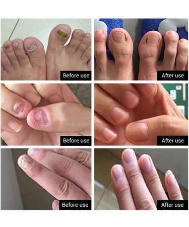 Beito 1PC Nail Repairs Solution de renouvellement des ongles l'huile essentielle tue les ongles fongiques Traitement fongique pour ongles cassants et craquel s (12ML) - Buy Online on GoSupps.com