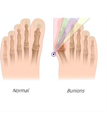 Bunion Corrector for Men and Women - Pain Relief Hallux Valgus Corrector Socks with Splint Pads and Cushion Guards - Orthopedic Support Brace and Toe Spacer for Hammer Toe Relief - Buy Online on GoSupps.com