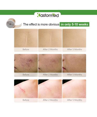 Silicone Tape for Scars - Soft Medical Tape for Keloid, Surgical, Burn, and Acne Scars - Tummy Tuck Post Surgery Supplies - 1.6 x 120 Roll - Buy Online on GoSupps.com