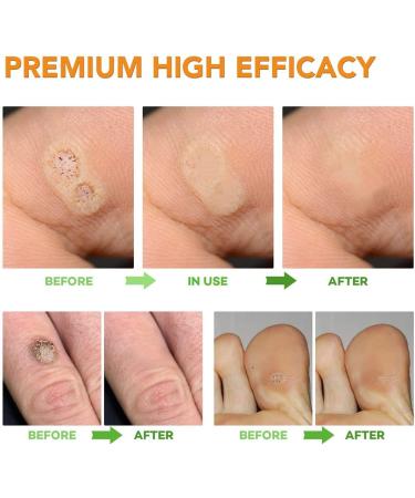 Samsali Wart Remover Pads - Potent 42-Count Treatment for High Efficacy Wart Removal - Buy Online on GoSupps.com