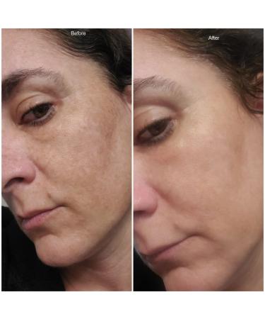 Dark Spot Corrector & Brightening Serum with Kojic Acid, Vitamin C, Salicylic Acid & More | Melasma Treatment Cream by Admire My Skin - Buy Online on GoSupps.com