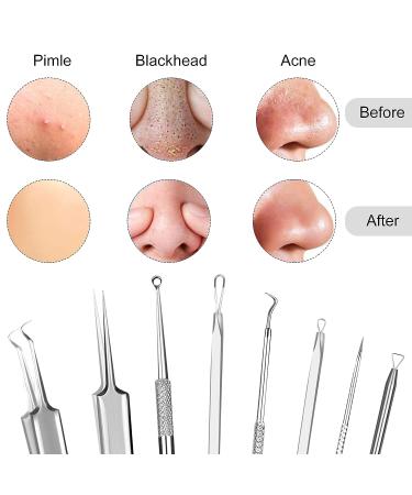Fluco 8pcs Blackhead Remover Pimple Popper Tool Kit for Nose & Face - Stainless Steel Blemish & Whitehead Extractor Set - Buy Online on GoSupps.com