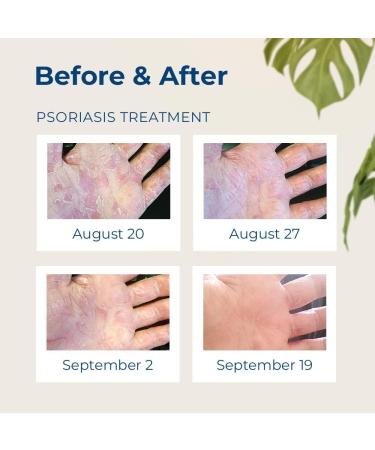 Gloves In A Bottle Psoriasis Eczema Relief Cream Set - Shielding Lotion for Women Men 6 Months Old/Older Babies- Cracked Hands Repair Cream (Original 8 oz + Botanical 3.4 oz) - Buy Online on GoSupps.com