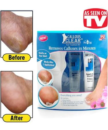 Callous Clear(TM) Foot Treatment Kit - Fast Callus Removal in Minutes - Buy Online on GoSupps.com