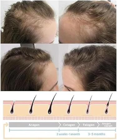 Hair Growth Wand Haute frequence baguette pour la croissance des cheveux Baguette de croissance des cheveux avec hair serum Baguette de croissance des cheveux avec 4 tubes diff rents (1 Blanc) 1 Blanc - Buy Online on GoSupps.com