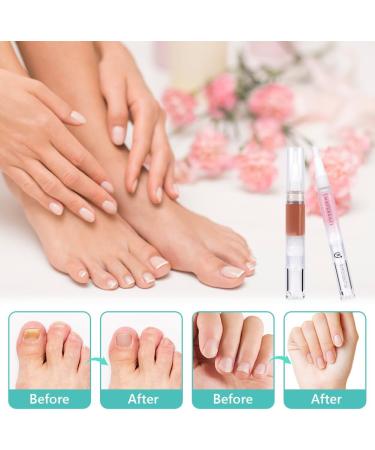 ACWOO Fungal Nail Treatment Set - 3PCS Anti Fungal Pen, Cuticle Oil, Nail File - Natural Plant Ingredients - Treat, Repair & Prevent Fungal Nail Infections - Buy Online on GoSupps.com