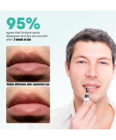 Abera Fordyce Cream Advanced Formula with HPR (Next-Gen Retinoids), Fordyce Spot Remover For Lips, All-day Moisturizing, Help Improve Dry, Chapped and Dark Lips, For Sensitive Lips (0.7 Oz) Set 1 - Buy Online on GoSupps.com