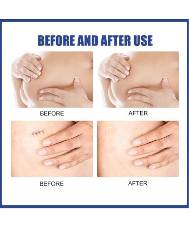 Silicone Breast Scar Sheets for Scar Reduction and Elasticity Restoration - Buy Online on GoSupps.com