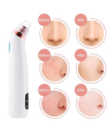 Blackhead Remover Pore Vacuum Cleaner Electric Acne Extractor Kit | LED Display, USB Rechargeable, All Skin Types | Gold - Buy Online on GoSupps.com
