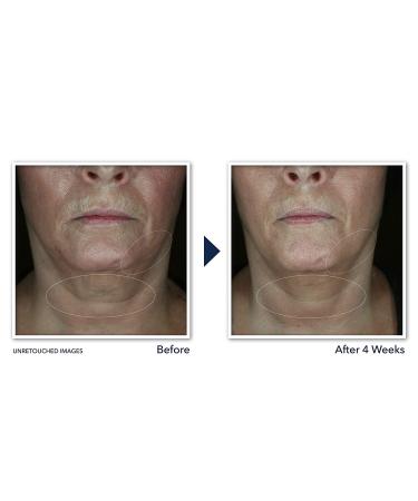 RoC Derm Correxion Neck Cream with Hyaluronic Acid and Retinol - Tighten & Lift Neck Lines - 1.7oz - Buy Online on GoSupps.com