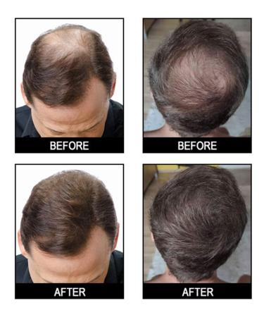 Gowwim Hair Thickening Fibers 2-in-1 Kit Set - Keratin Building Fibers & Spray Applicator - Instantly Cover Sparse Hair - Black - Buy Online on GoSupps.com