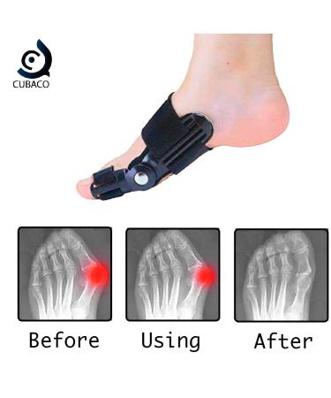 Cubaco Articulated Bunion Corrector & Separator - Black | Relieve Pain & Improve Alignment - Buy Online on GoSupps.com