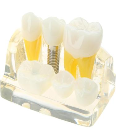 Implant Model Removable Bridge - Educational Teeth Model for Dental Studies | Perfect for Demonstration Classes - Buy Online on GoSupps.com