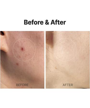 MEDITHERAPY A Clearing Toner Swab - Vegan Soft Exfoliator for Acne-Prone Skin Pore Tightening Korean Skincare - Buy Online on GoSupps.com