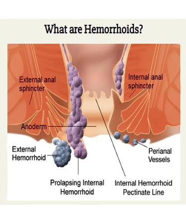 Heca Natural Herbal Hemorrhoid Capsules - Rapid Relief Suppository for Quick Discomfort Treatment - 3pcs - Buy Online on GoSupps.com