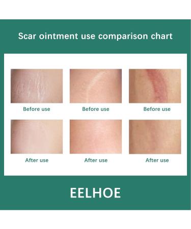 DAUERHAFT Scar Care Cream - Reduce Wrinkles, Surgery Scars, Irritation-Free - Women's Scar Removal Cream - Buy Online on GoSupps.com