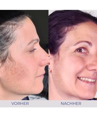 Omnimedica Natural Sunscreen SPF 30 - Body & Facial Protection Against Pigment Spots with Swiss OM24 Green Tea Extract - 100ml for All Skin Types - Buy Online on GoSupps.com