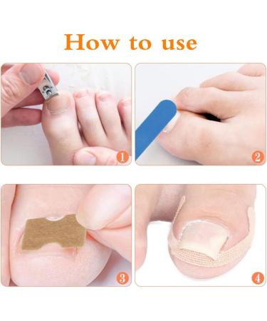 124 PCS Ingrown Toenail Kit 2 Styles Breathable Self-Adhesive Elastic Toenail Correction Patch for Toenail Treatment Fingernail Care Protect Toe Nail Nail groove correction gray nail toe care - Buy Online on GoSupps.com