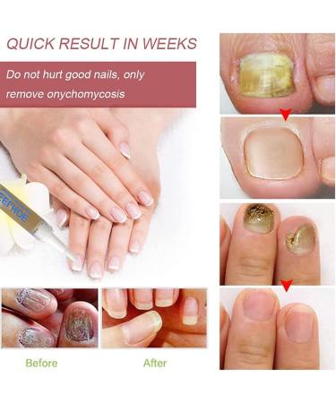 Okita Toenail Fungus Treatment Pen - Effective Nail Repair for Healthy and Strong Nails (5Pcs) - Buy Online on GoSupps.com