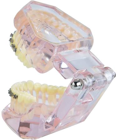 Buy Dental Teeth Model Demo | Transparent Implant & Orthodontic Retainer | International Shipping - Buy Online on GoSupps.com