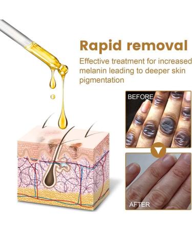 LKTM 3/4/5 Boxes NigriCare Therapy Drops.10ml Acanthosis Nigricans Therapy Oil for Everyone (5PCS) - Buy Online on GoSupps.com