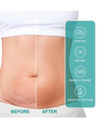 Advanced Scar Remover - Fade Dark Acne, Surgical Scars, Stretch Marks - Gentle Care for Prone Skin (5 PCS) - Buy Online on GoSupps.com