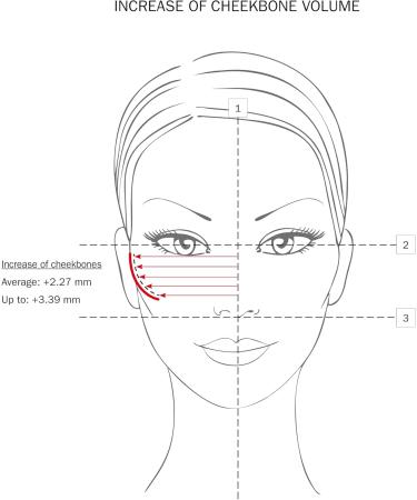 Dermo Cosmetic Filler Treatment Grade 3 2x30ml - Buy Online on GoSupps.com