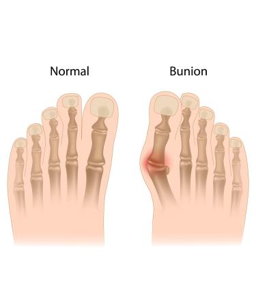 Healtheveryday Soft Silicone Bunion Toes Protector | 3rd Gen Cushion Splint Pad Spreader for Foot Pain Relief - Unisex - Buy Online on GoSupps.com