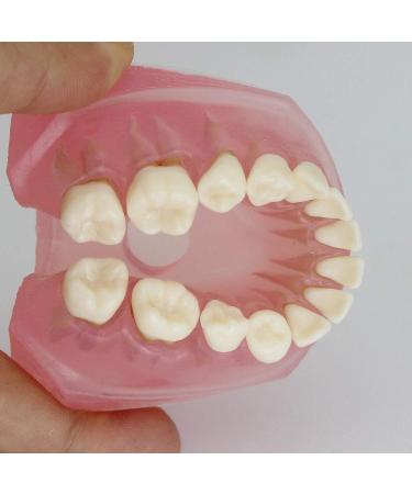 Samnuerly 28 Removable Teeth Dental Implant Model - Translucent Standard for Research & Teaching - Ideal for Removable Lower Jaw - Buy Online on GoSupps.com