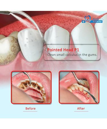 10x P1 Dental Equipment Tip: High-Quality Accessory for Precision Care - Buy Online on GoSupps.com