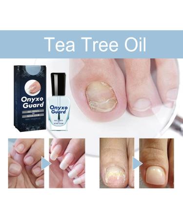 Onyxoguard Nail Growth And Repair Serum Nail Serum Repair Essence Nail Growth And Strengthener Nourish Strengthen And Revitalize Your Nails (3pcs) - Buy Online on GoSupps.com