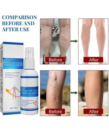 6-Piece Anti-Varicose Veins Cream & Spray Set - Soothing Relief for Tired Legs - Reduces Appearance of Varicose Veins - Buy Online on GoSupps.com
