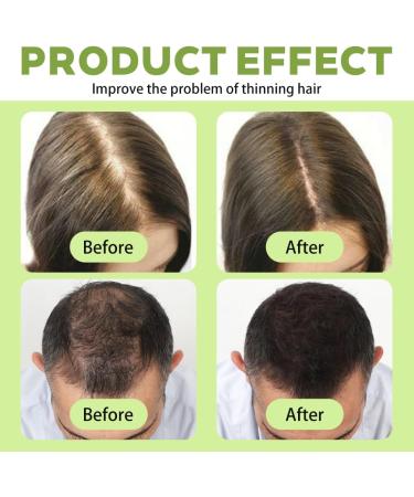 Allphaiefusaed Hair Regrowth System Repousse Cheveux Micro Infusion system Syst me de Repousse des Cheveux Densifie et Renforce les cheveux d s la Racine (5 ml x 6) - Buy Online on GoSupps.com