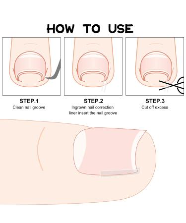 Ingrown Toenail Corrector Strips - 60 Pieces | Toe Nail Correction Brace for Men and Women | Foot Care Solution - 2 Styles Available - Buy Online on GoSupps.com