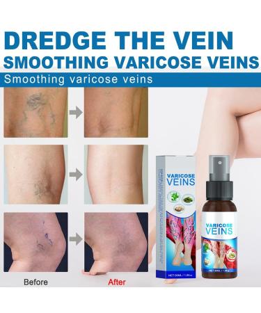 3 Piece Varicose Vein Treatment Spray Set | Soothing Vein Healing Spray for Legs | Effective Relief for Varicose Veins - Buy Online on GoSupps.com