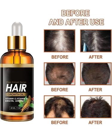 30ml Ginger Hair Growth Serum Hair Growth Treatment Oil for Men Women Anti Hair Loss Thinning Promote Hair Regrowth - Buy Online on GoSupps.com