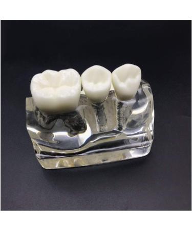 4x Enlarged Teeth Model for Dental Education | Implant & Crown Simulation | Ideal for Teaching & Demonstration - Buy Online on GoSupps.com