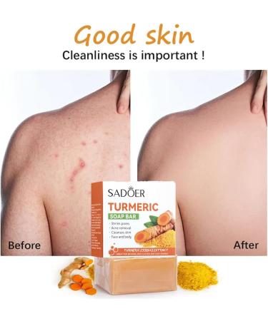 Kojic Acid Soap Turmeric Soap Bar Vitamin C soap Bar Mild soap for Removing acne Blackheads and Dark Spots Deeply Cleaning Hyaluronic Acid and Moisturizing Face and Body yellow - Buy Online on GoSupps.com