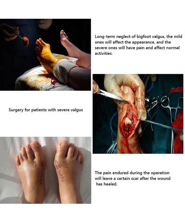 Urisgo Hallux Valgus Correction: Orthopedic Bunion Rail for Great Toe Pain Relief & Support - 2 Pieces for Day/Night Use - Buy Online on GoSupps.com
