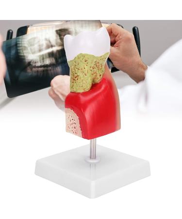 Verdant Touch Tooth Model - Dental Caries Teaching & Training Aid for Patient Education - International Shipping - Buy Online on GoSupps.com