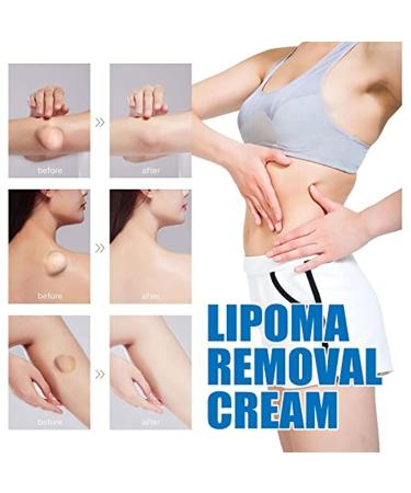 3pcs Lipoma Removal Cream for Anti-Swelling & Cellulite Elimination | Lymphatic Ointment for Lipoma Exfoliation - Buy Online on GoSupps.com