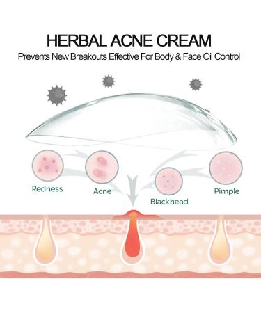 Acne Cream - Tea Tree Oil Anti Acne Removal Cream For Acne Treatment And Spot Treatment - Spot Cream For Acne & Spot With Herbal Extract - Face Blemishes & Blackheads Fade Acne Spots Shrink Pores - Buy Online on GoSupps.com