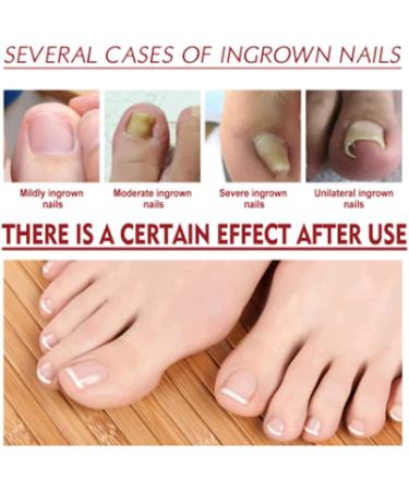 ToenailPlus Lot de 3 huiles de soulagement anti-paronychia allemande pour ongles d'orteils incarn s orteils et ongles des doigts pour ongles pais endommag s et d color s - Buy Online on GoSupps.com