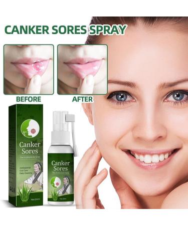 Antiviral Oral Ulcer & Canker Relief Spray 20ML - Herbal Breath Freshener - Buy Online on GoSupps.com